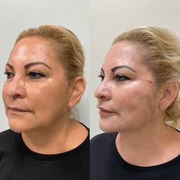 pdo-thread-lift-before-and-after-face